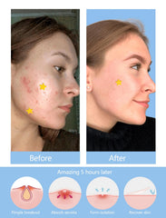 SVIPTP ingredient label with tea tree salicylic cica highlighting gentle support