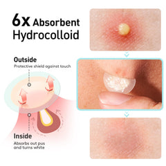 TKTK patch applied to cheek protecting a blemish and reducing picking