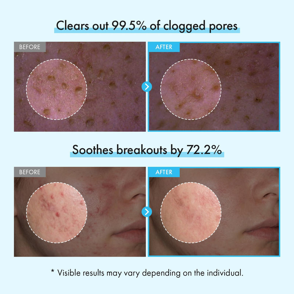 TOSOWOONG capsule close-up revealing micro capsules that absorb sebum