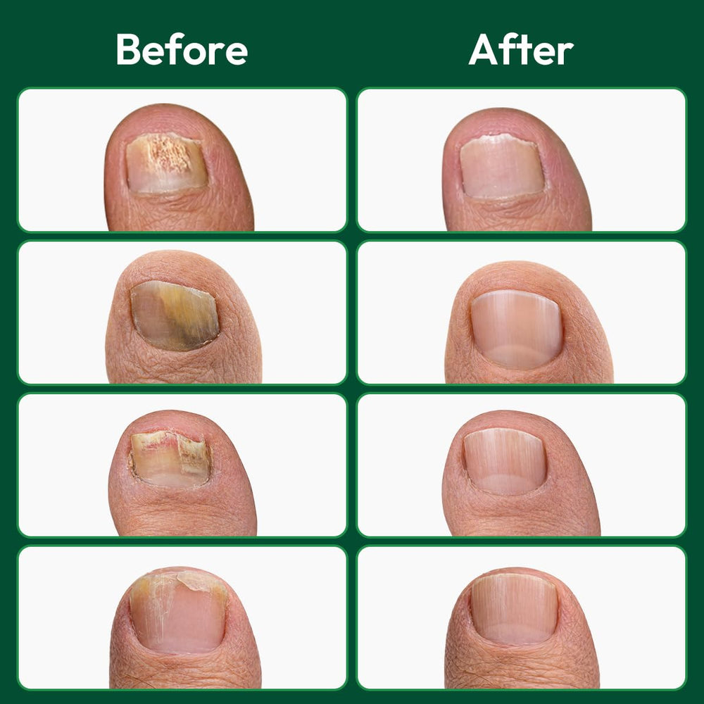 VERDORA patch applied to toenail demonstrating secure fit