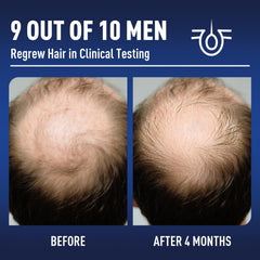 Wuwenbin bottle close-up label highlighting minoxidil and biotin ingredients