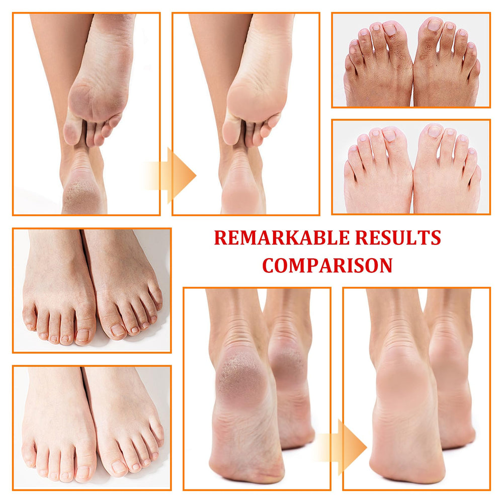 XMXueMei before and after feet showing smoother, exfoliated result