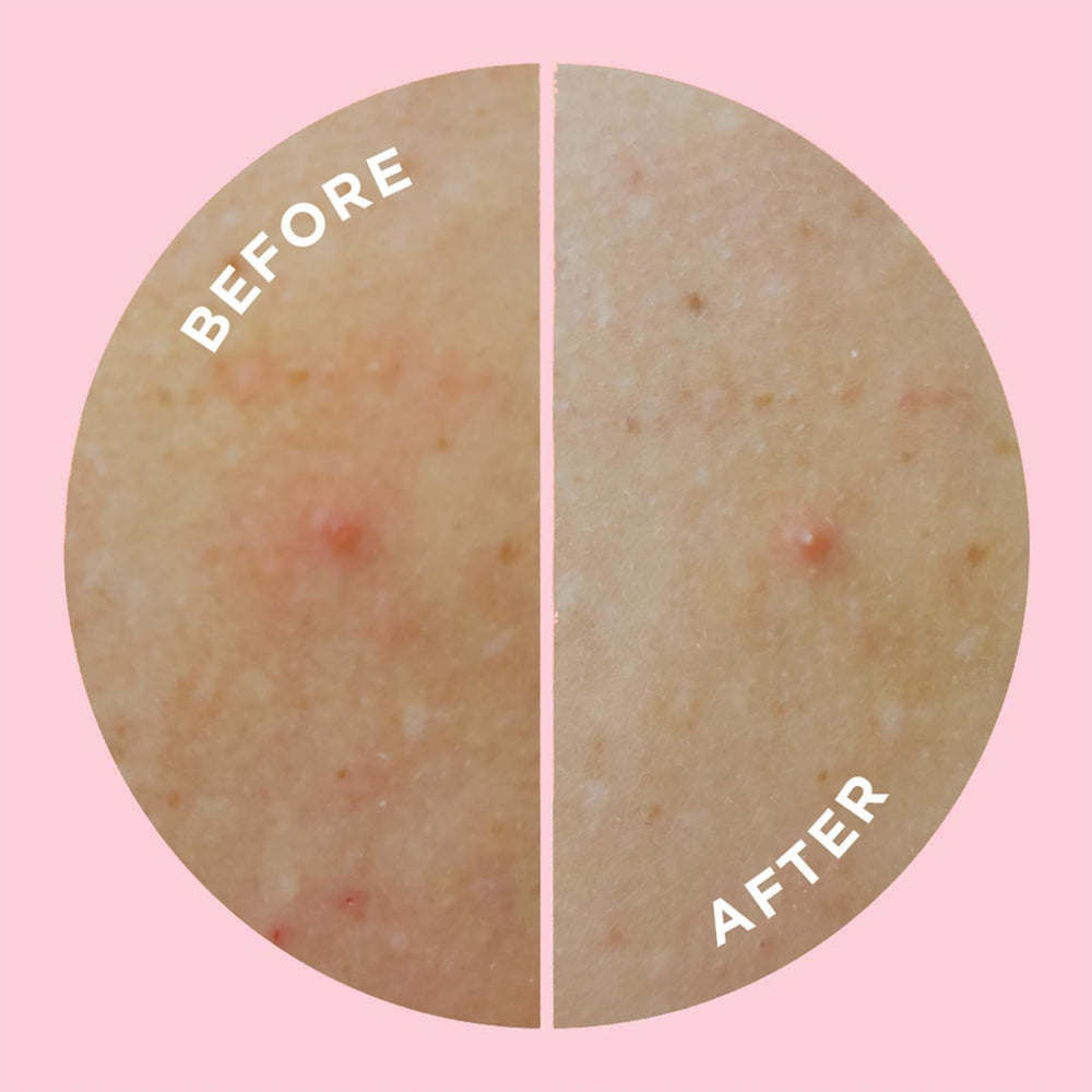 ZitSticka ingredients label highlighting salicylic acid and niacinamide