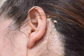 111MedCo applying bar to beard area to reduce visible flakes