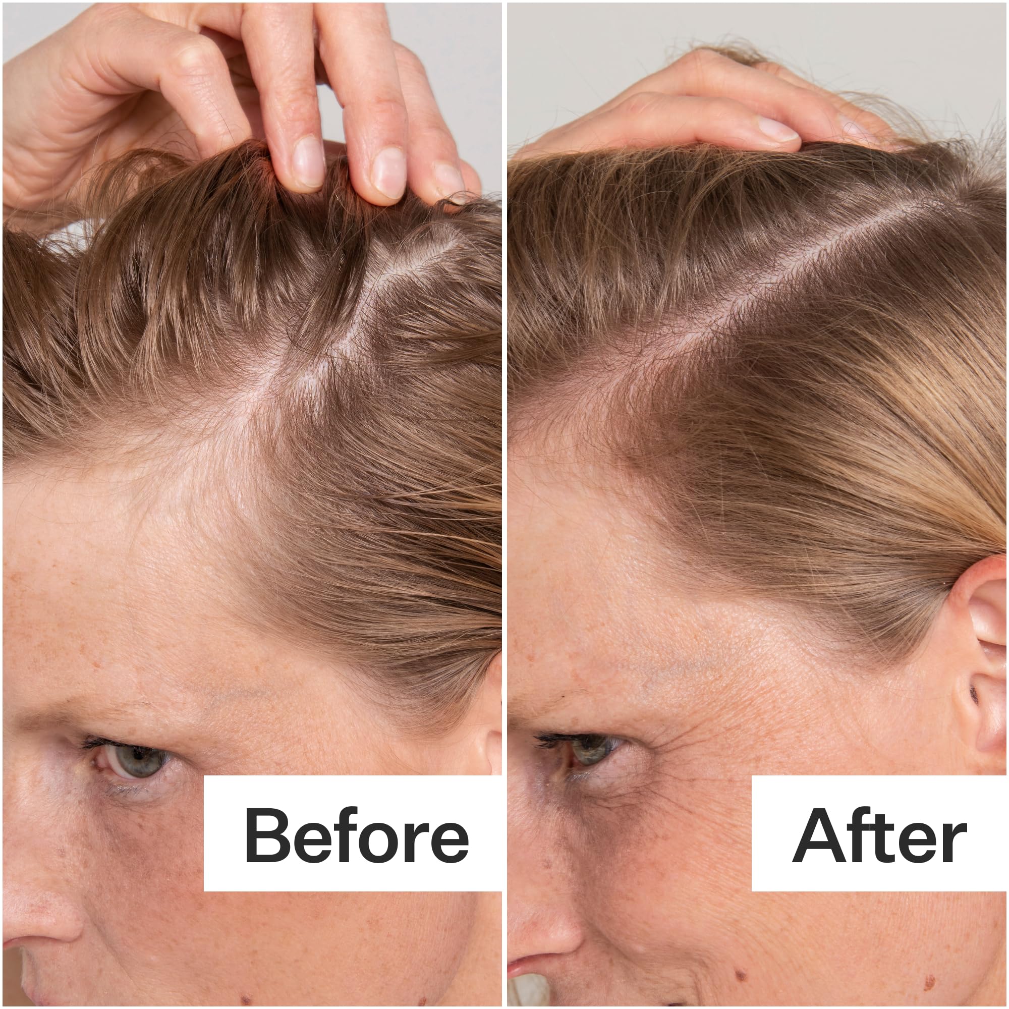 ACT+ ACRE applying exfoliator to scalp for targeted buildup removal