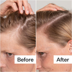 ACT+ ACRE applying exfoliator to scalp for targeted buildup removal