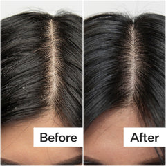 ACT+ ACRE label close-up highlighting salicylic acid and papaya extract