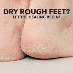 Adamia cream applied to heel to show softening and hydration