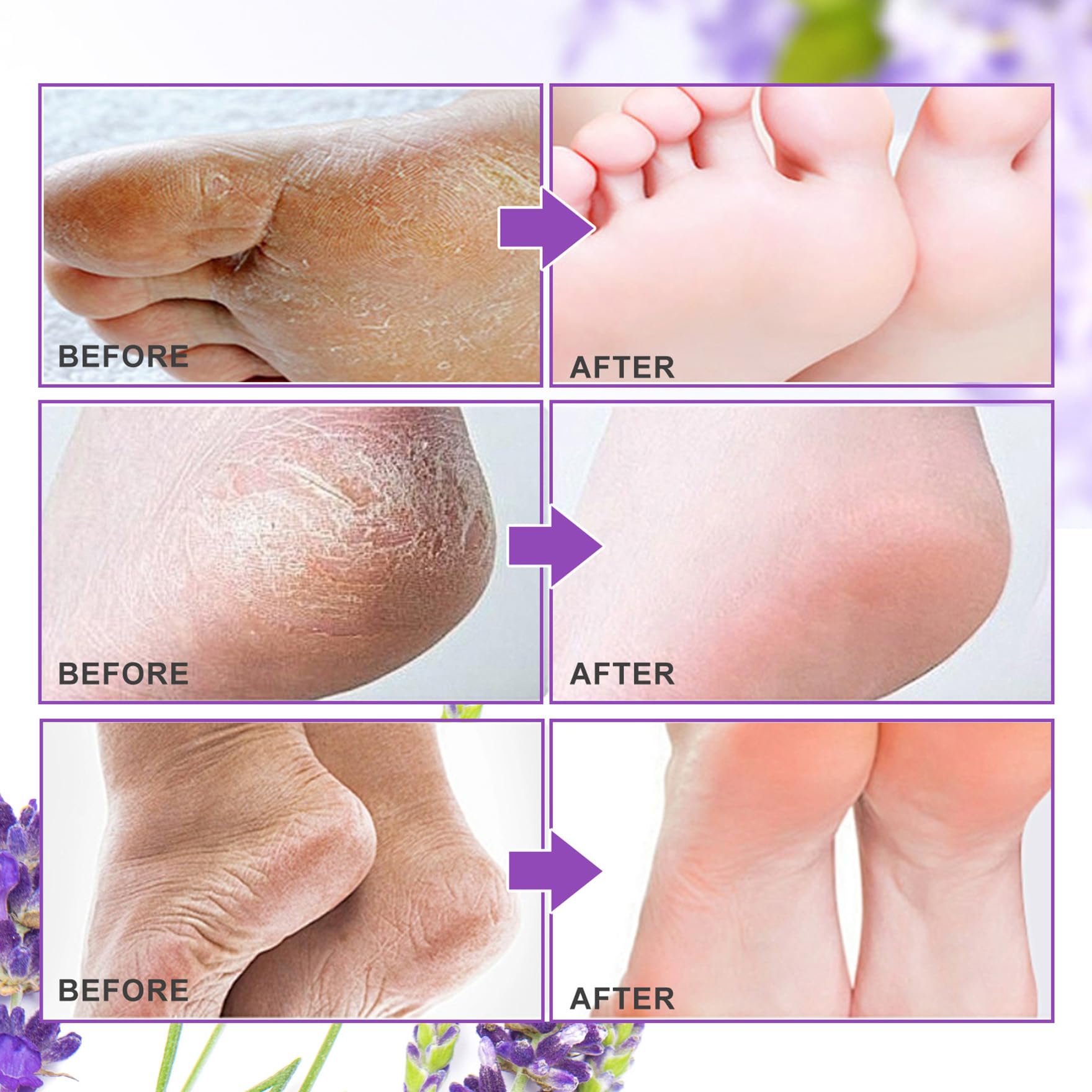 ALIVER peeling process showing shedding skin for smoother feet