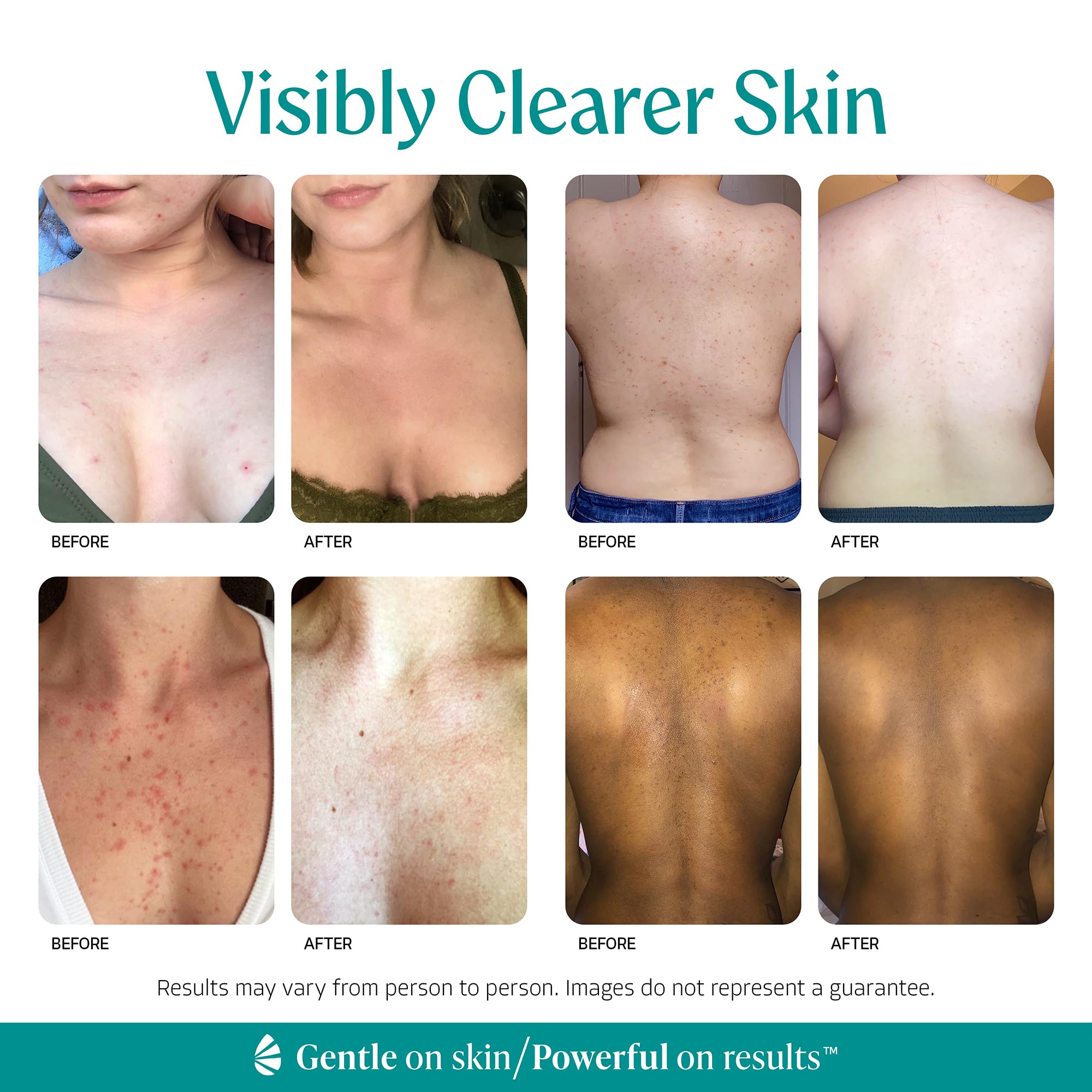 Almond Clear applied to back to treat body acne and reduce folliculitis inflammation