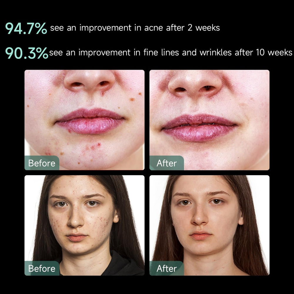 Aphrona mask worn by model demonstrating hands-free treatment convenience