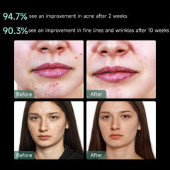 Aphrona mask worn by model demonstrating hands-free treatment convenience