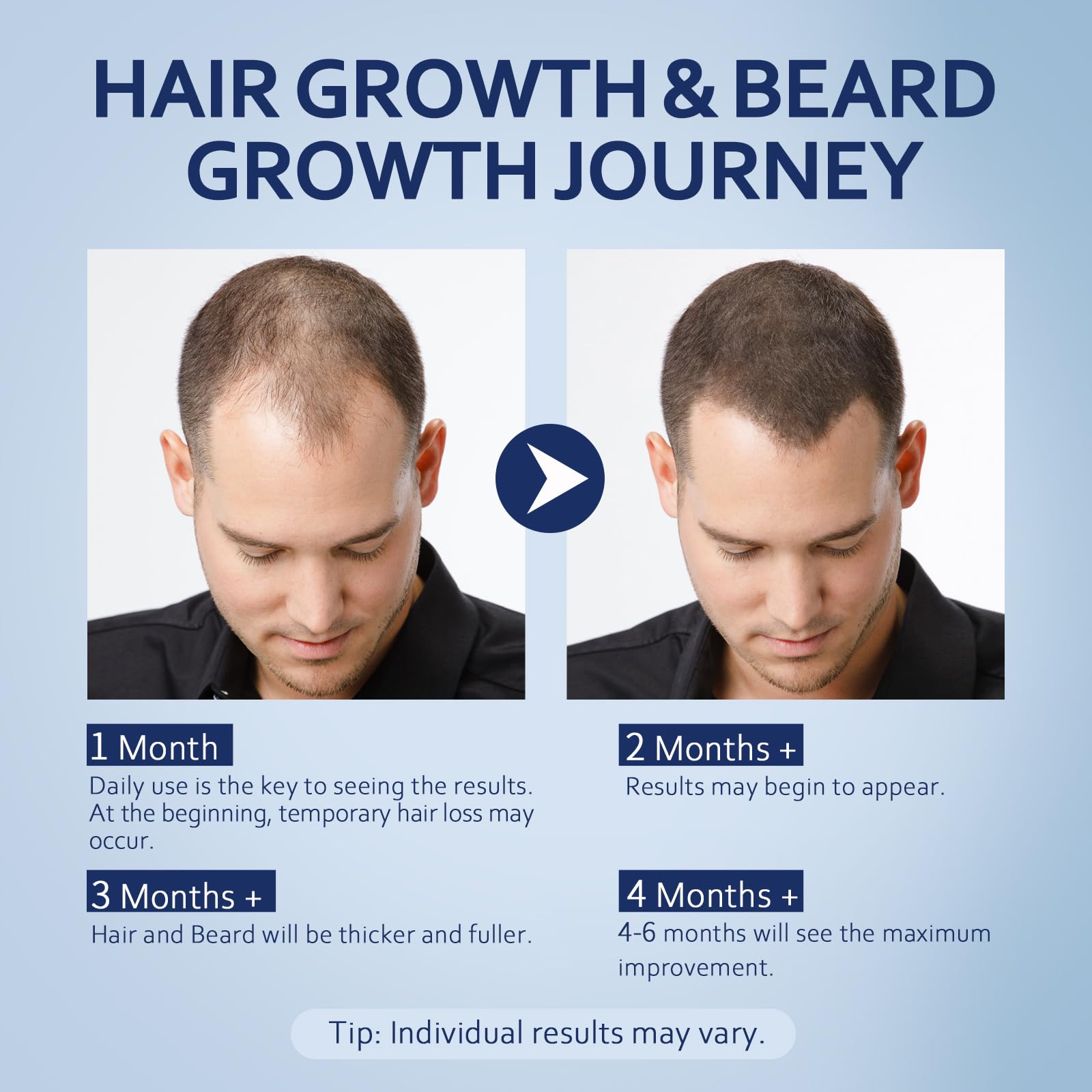Applying Artimore solution to scalp illustrating targeted coverage and simple twice-daily routine