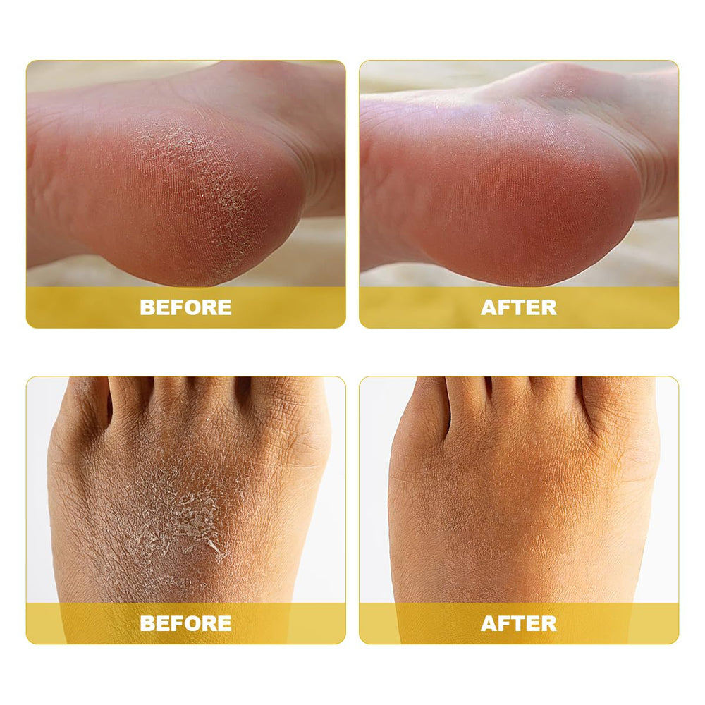ASDToTio spray applied to heel illustrating quick exfoliation support