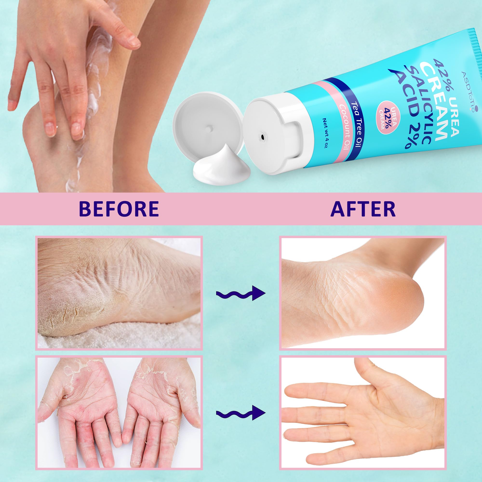 ASDToTio cream applied before bed with socks illustrating overnight intensive care