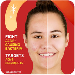 Asepxia cream on fingertip ready for spot application to calm blemishes