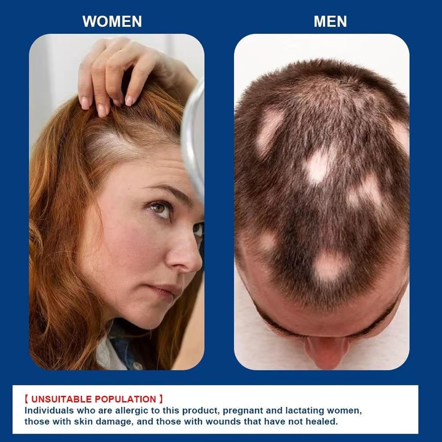 ATHNO applying cream to beard area showing precise application for patchy beard care