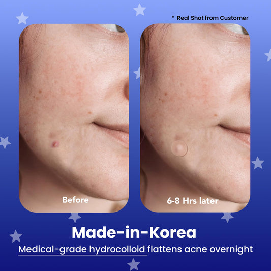 AVARELLE close-up of hydrocolloid patch texture showing absorbent layer