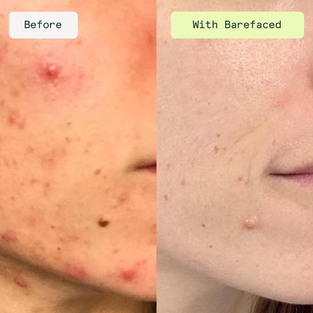 Barefaced open jar with stacked pads ready to use for fast exfoliation