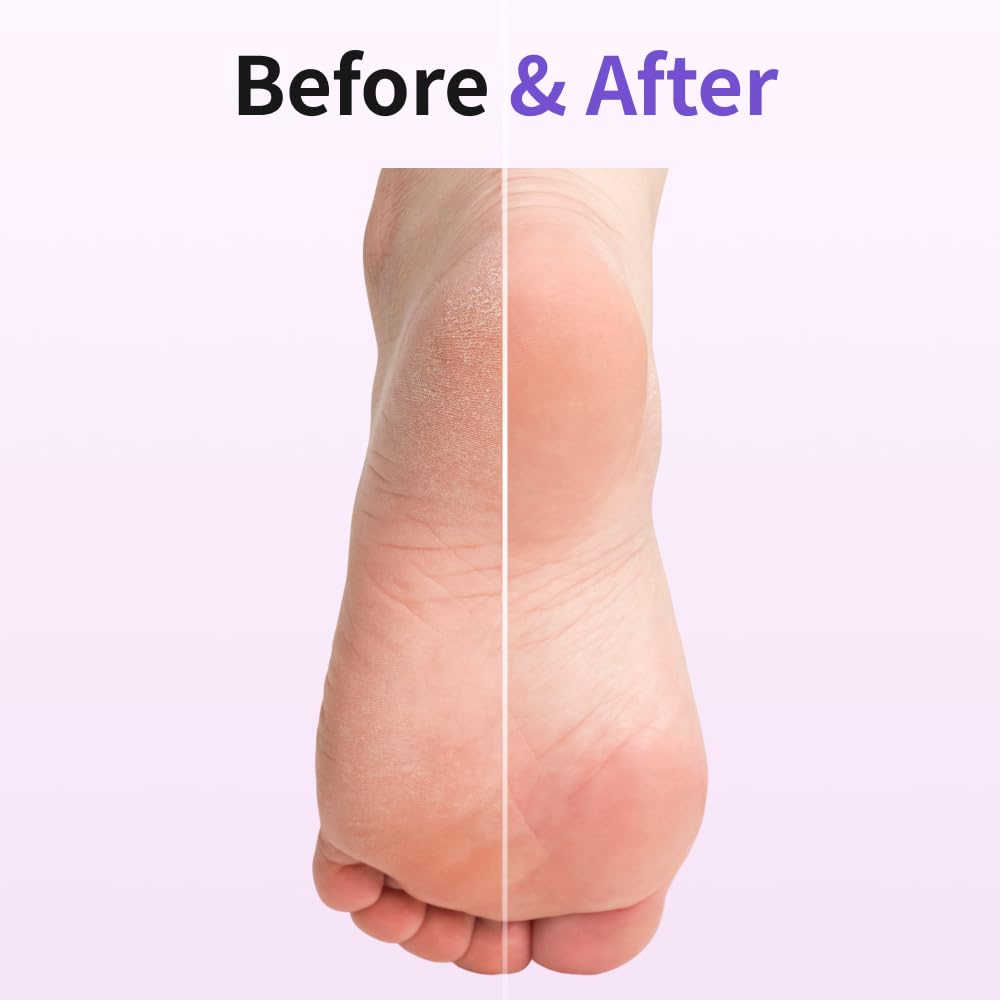 Baren applying balm to heel in hand for immediate hydration