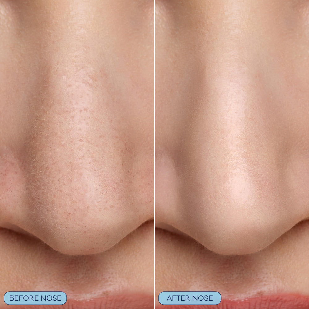 Bioré bubbling nose mask on skin demonstrating deep pore cleaning
