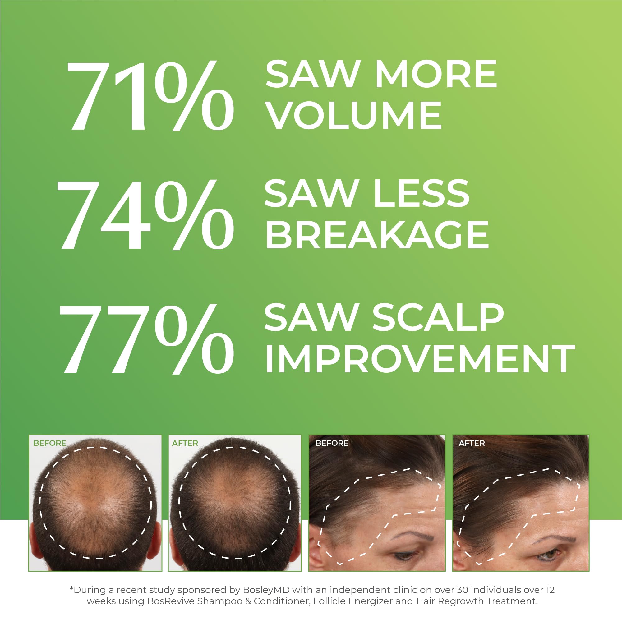 BosleyMD applied to scalp demonstrating targeted use and improved scalp care