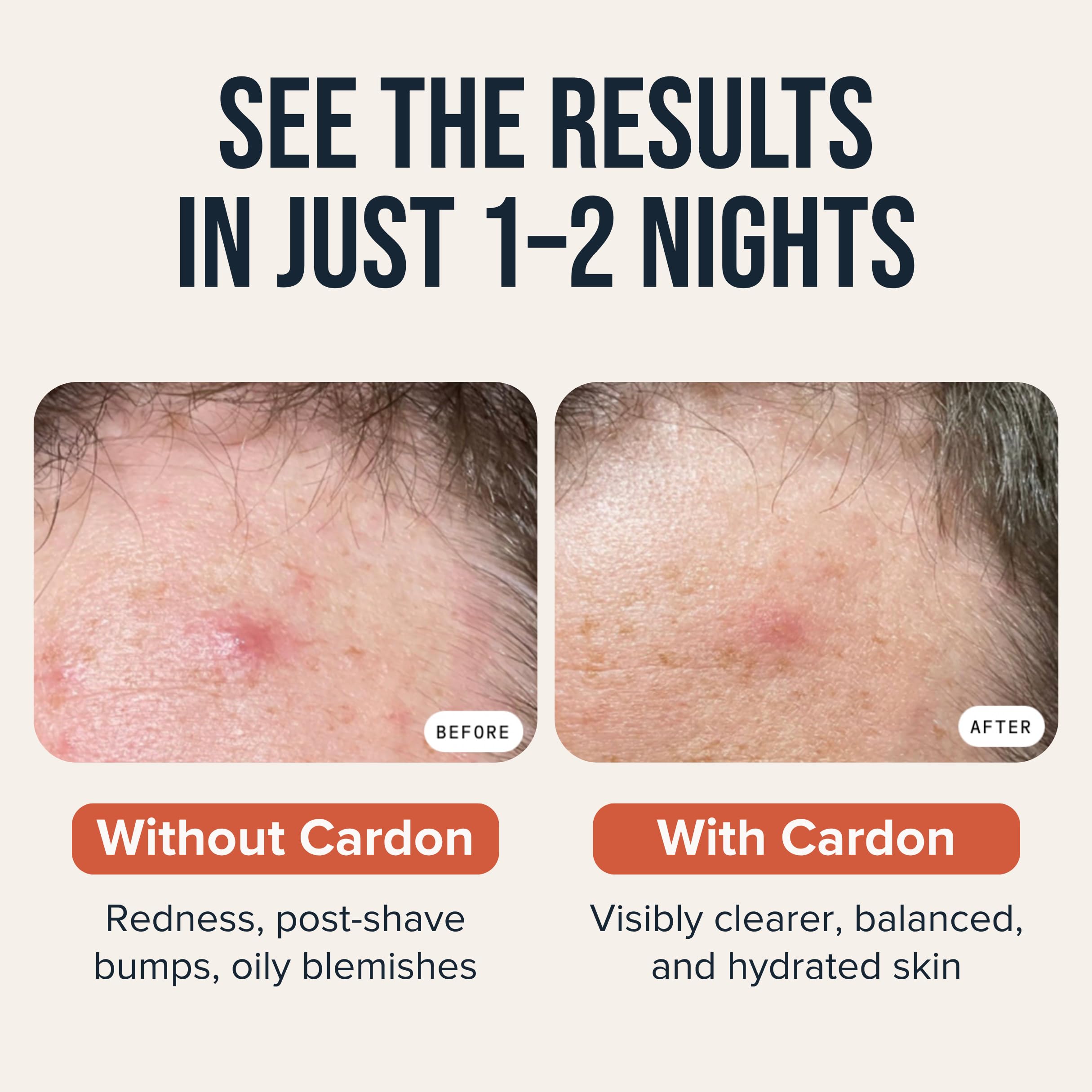 Cardon adhesive patch applied to cheek for overnight blemish treatment