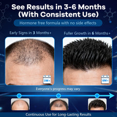 CARENICE label close-up highlighting minoxidil and biotin content