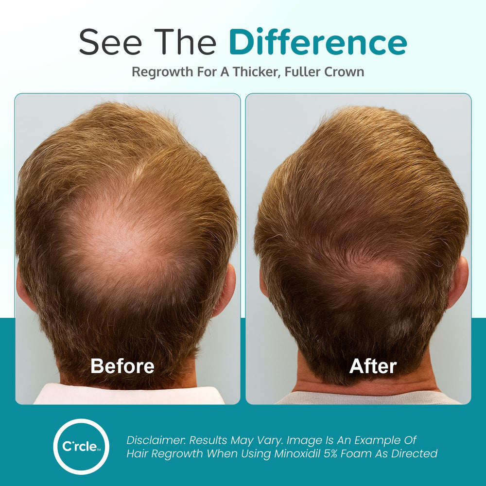 C'rcle foam being applied to scalp targeting vertex thinning for coverage