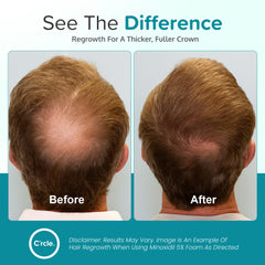 C'rcle foam being applied to scalp targeting vertex thinning for coverage