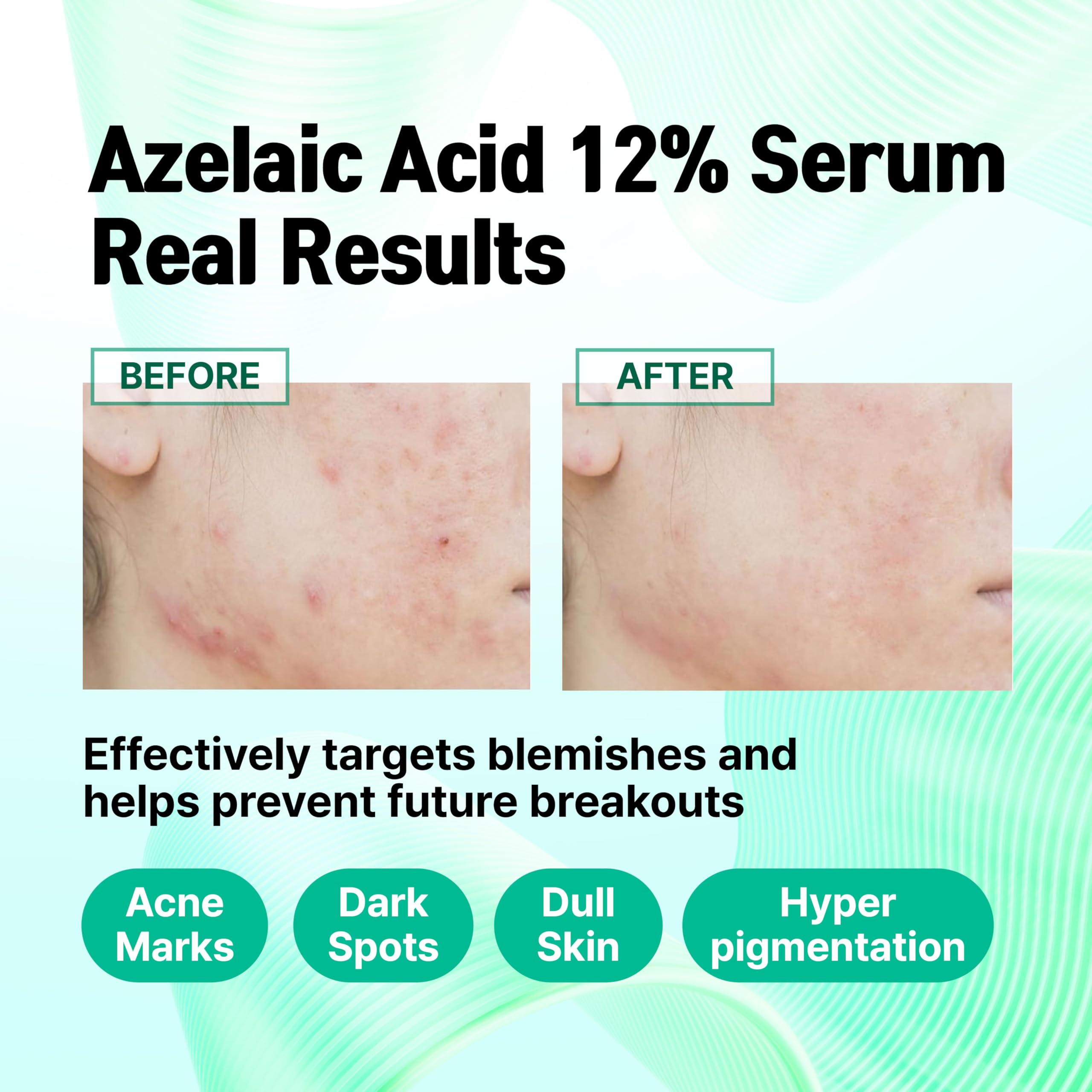 CELDYQUE product label close-up listing azelaic acid and key actives clearly