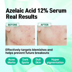 CELDYQUE product label close-up listing azelaic acid and key actives clearly