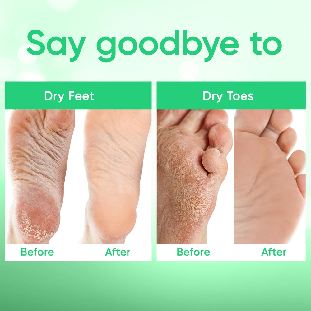 CÉLOR before and after feet comparison showing reduced calluses and softer skin