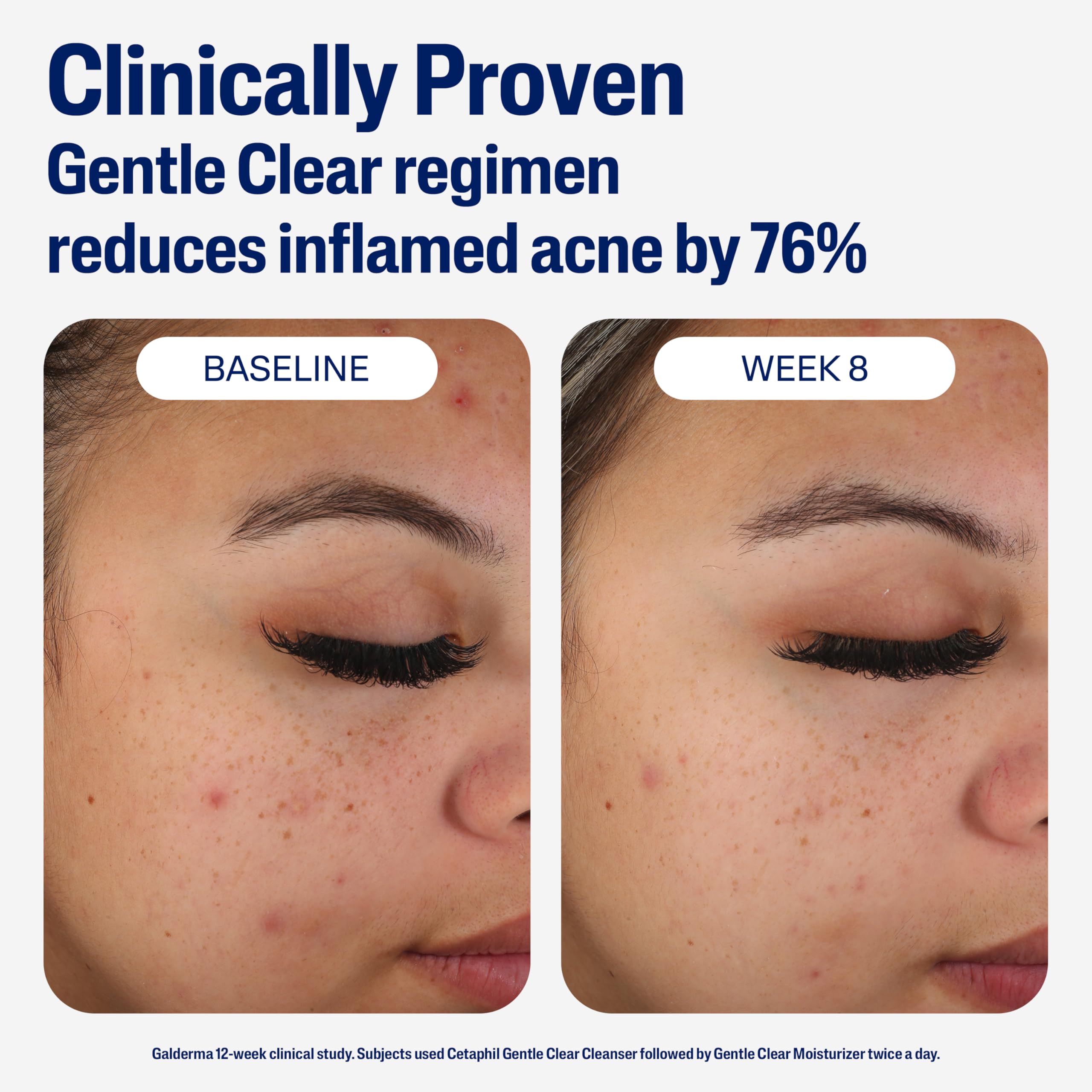Cetaphil bottle next to cleanser suggesting gentle daily acne-care routine