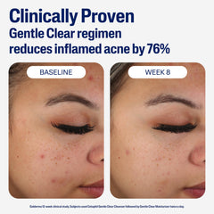 Cetaphil bottle next to cleanser suggesting gentle daily acne-care routine