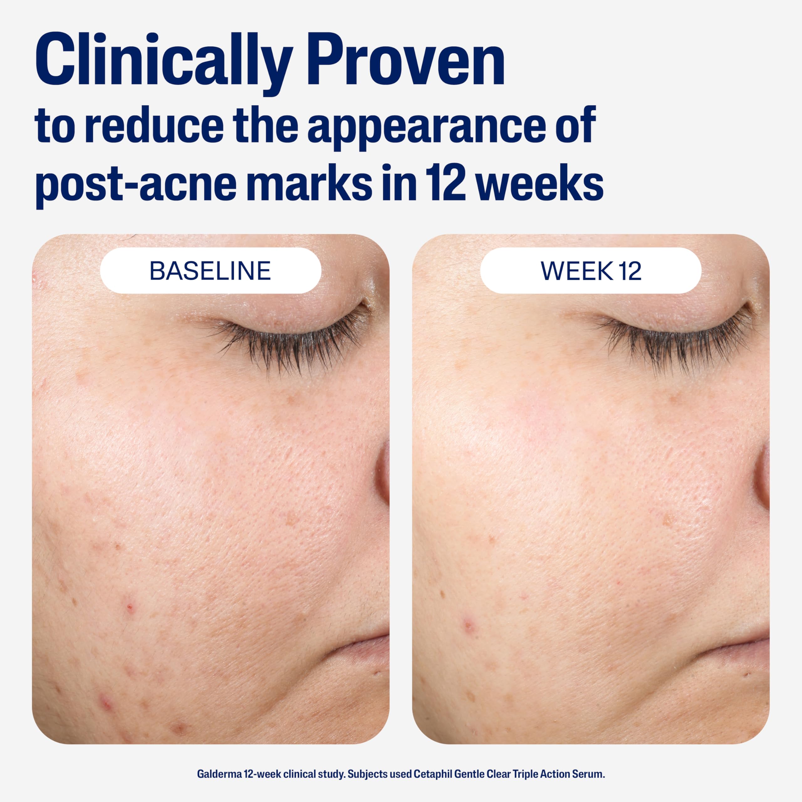 Cetaphil zinc ingredient close-up showing oil-absorbing benefit and matte finish