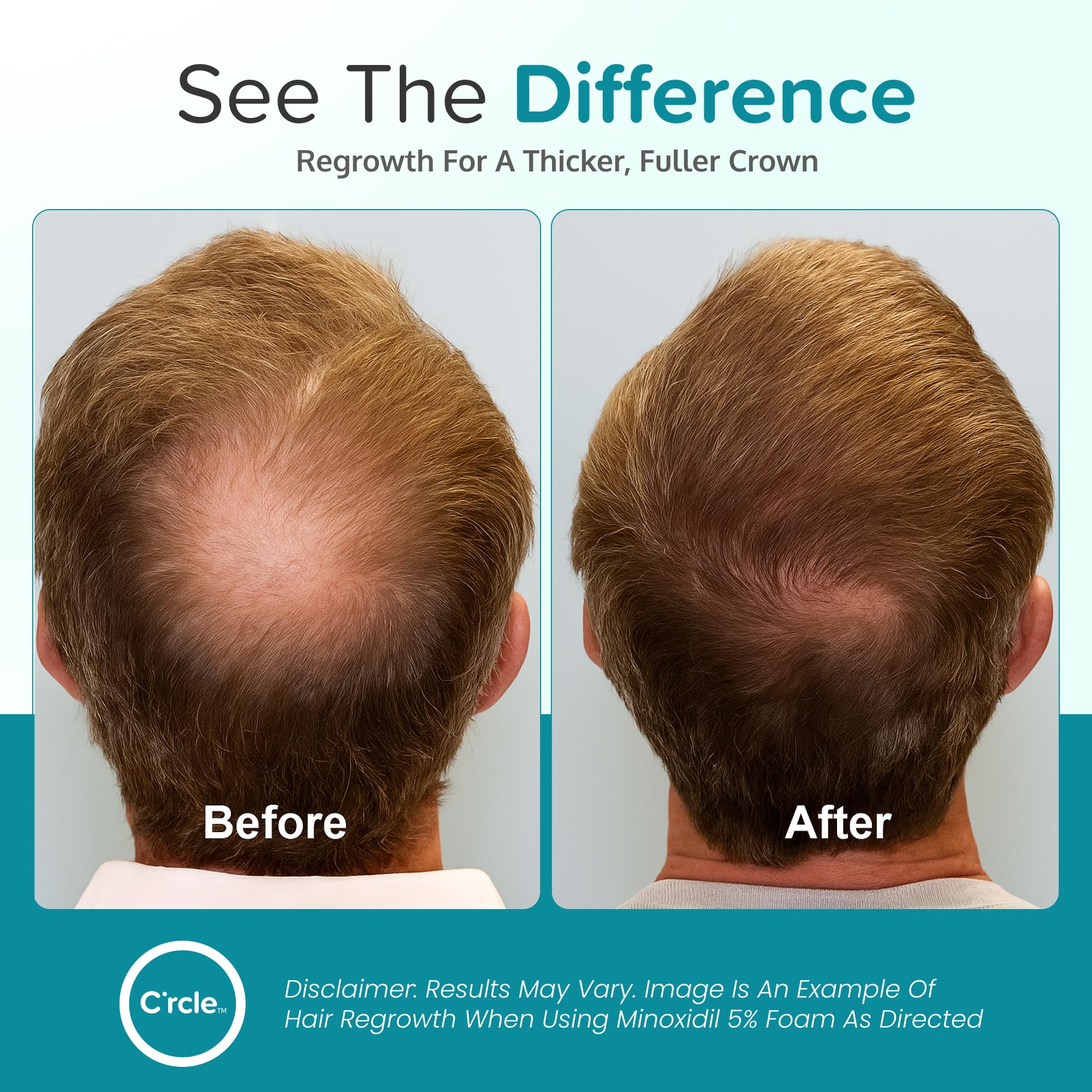 C'rcle foam being applied to vertex scalp to target thinning effectively