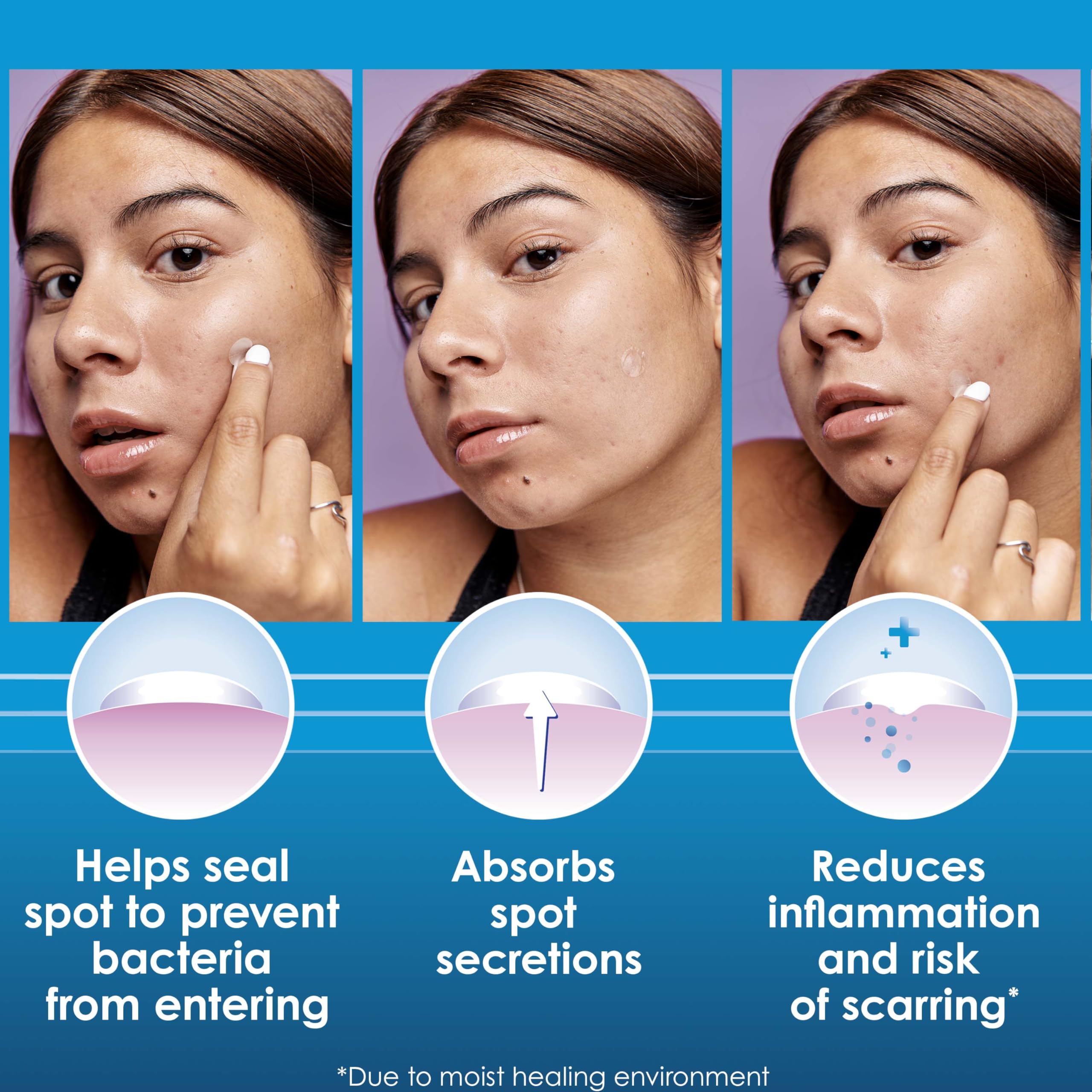Clearasil patch close-up texture showing hydrocolloid surface and adhesion advantage