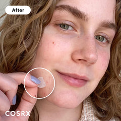 COSRX patch applied on cheek demonstrating secure adhesion and protection