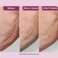 DEKLIDERM being applied to neck to visibly smooth and firm skin