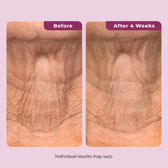 DEKLIDERM applied to upper arm showing improved firmness and softness