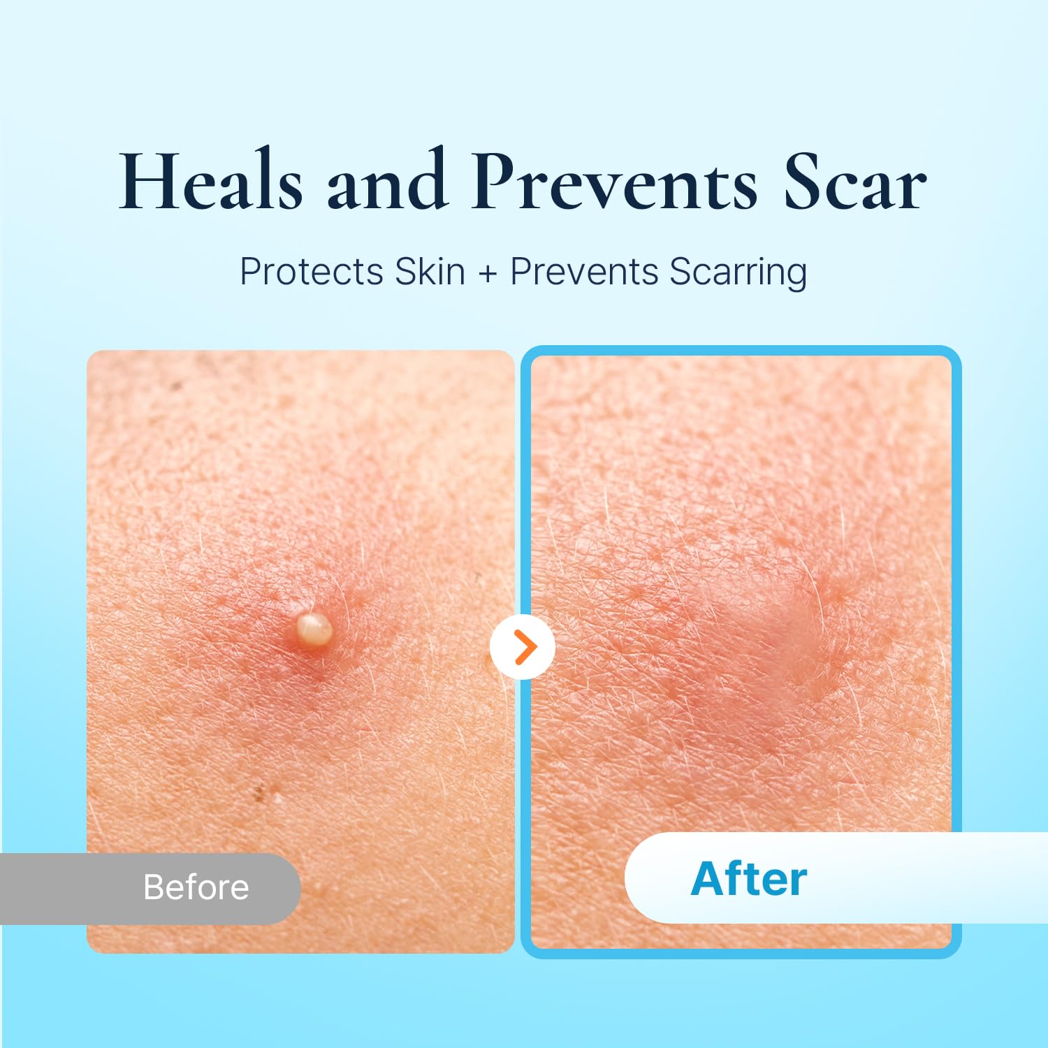 DERMAKR patches worn on a model’s face during day, natural cover and comfort benefit
