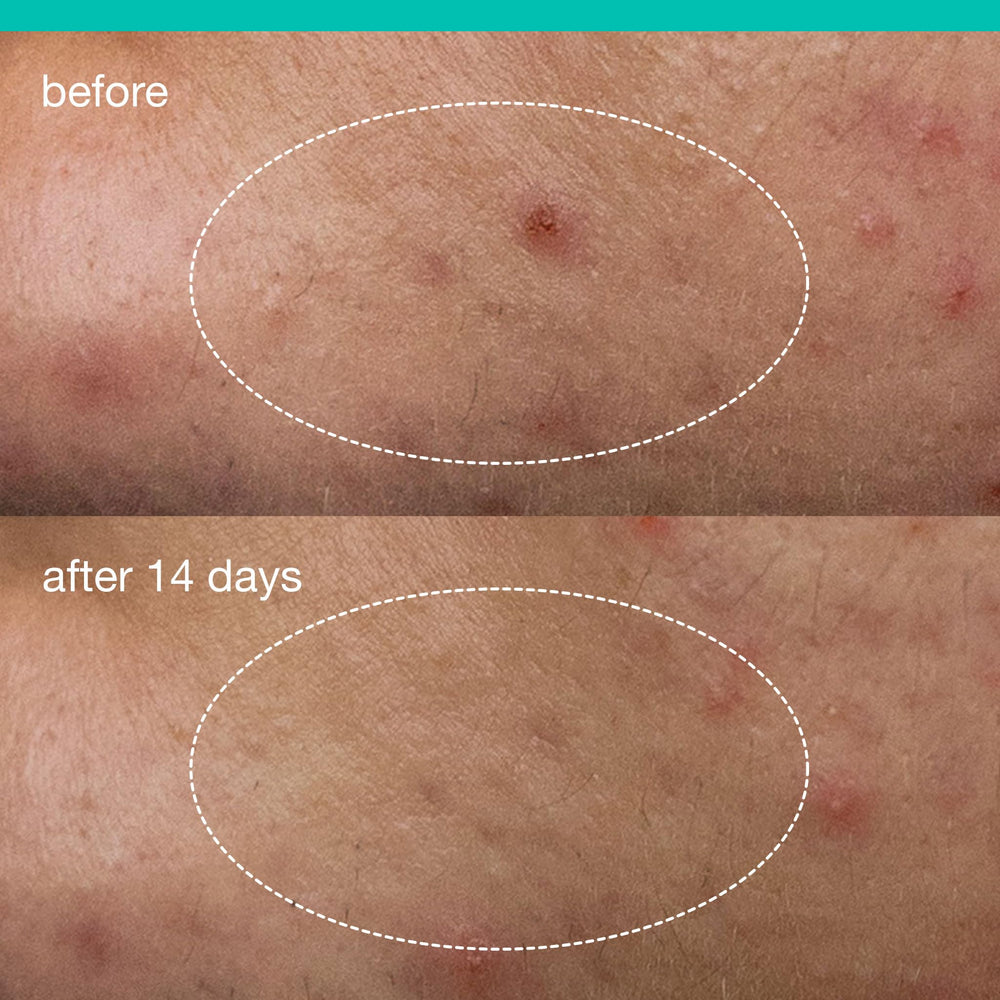Dermalogica invisible patch formed on skin showing breathable protection benefit