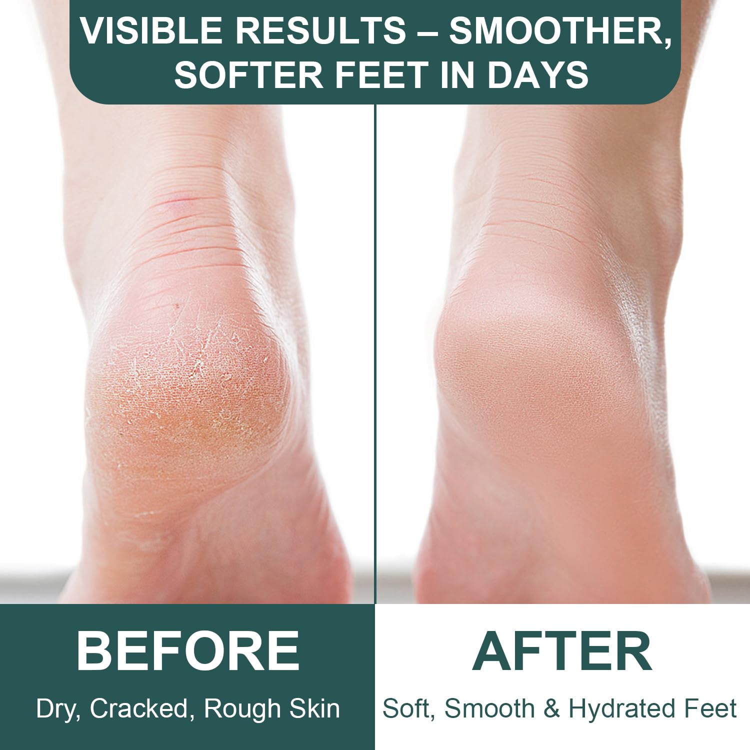 Devyonder applied to heel demonstrating callus softening benefit