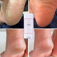 DIANA'S DREAM before and after feet comparison showing smoother hydrated heels
