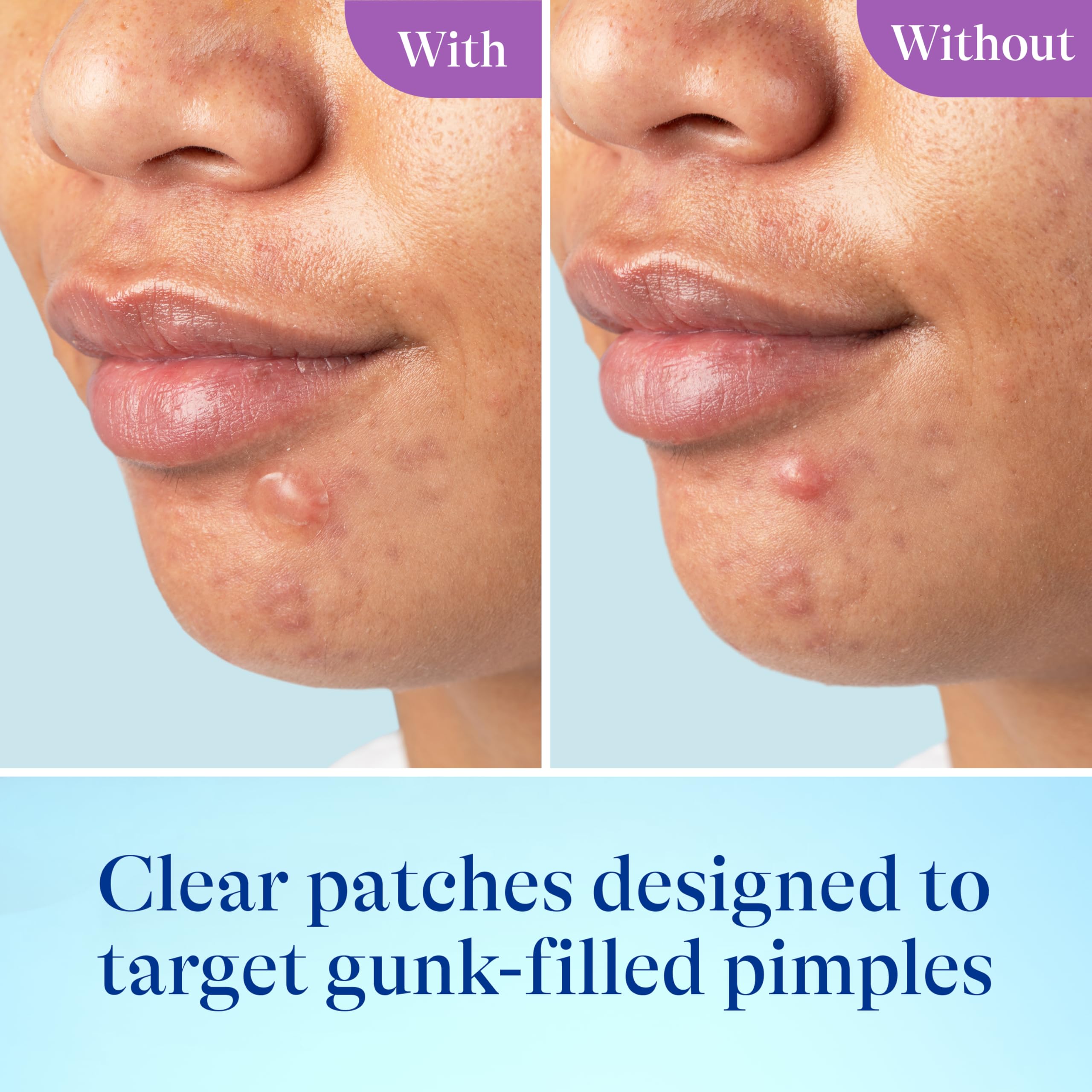Differin small patch on chin, discreet spot coverage benefit