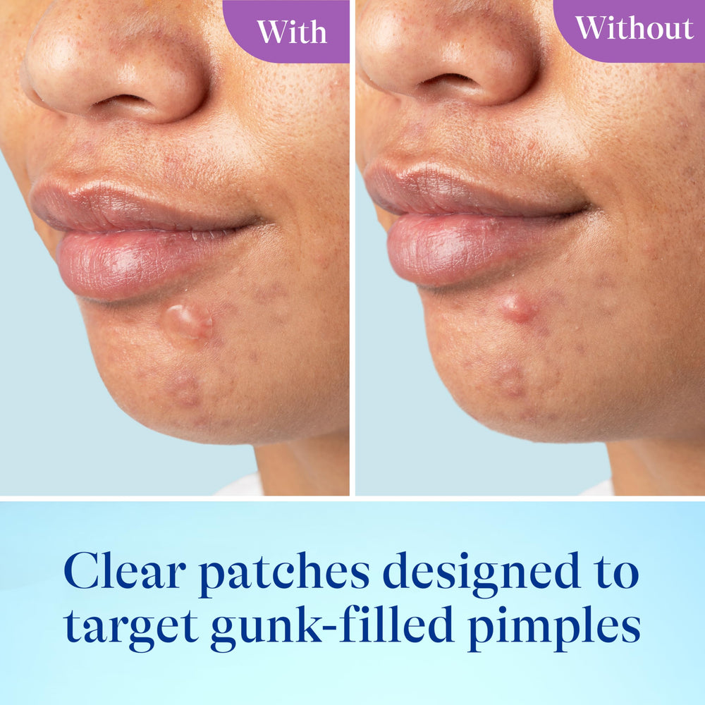 Differin small patch on chin, discreet spot coverage benefit