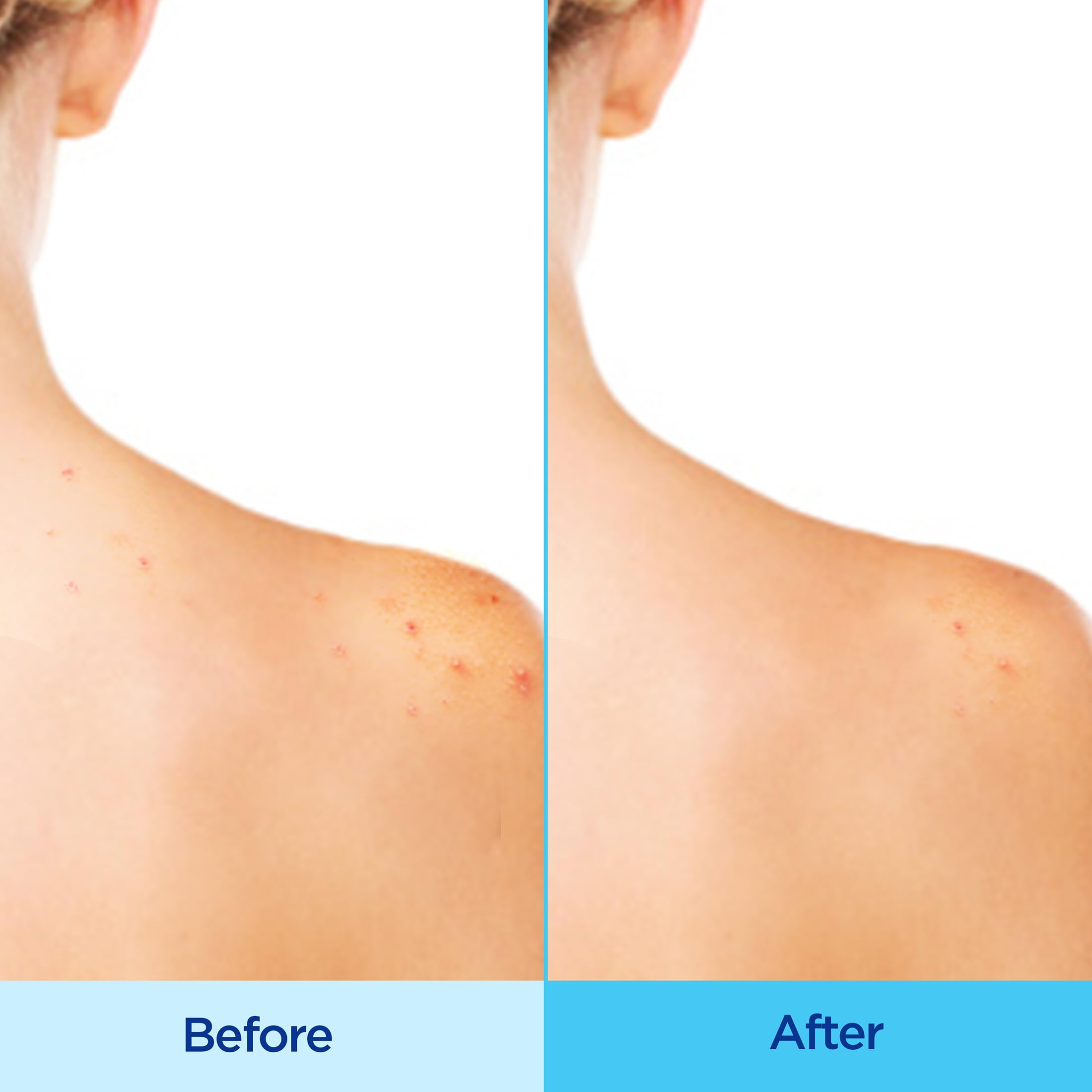 Differin spray texture on skin highlighting fast-drying, non-greasy finish