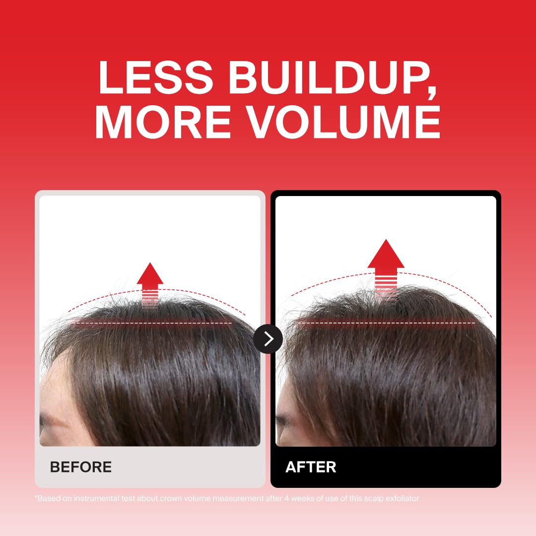 DR.FORHAIR applied on damp scalp demonstrating targeted exfoliation