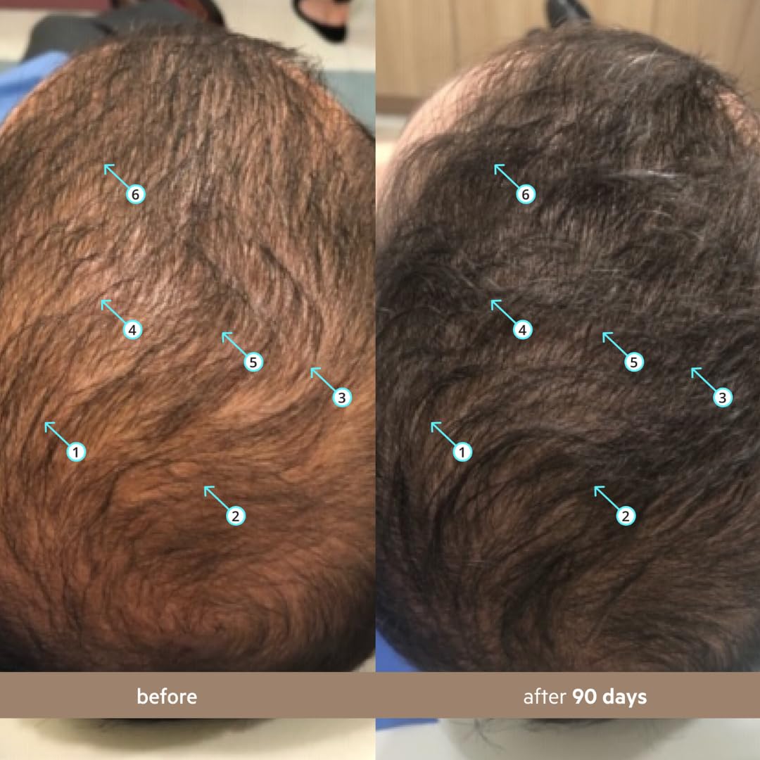 DS Laboratories application demo on scalp targeting thinning areas